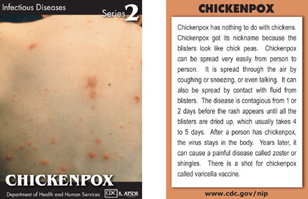 Infectious Disease Trading Cards - Series 2 - Chicken Pox