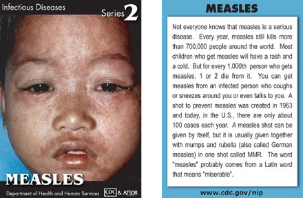 Infectious Disease Trading Cards - Series 2 - Measles