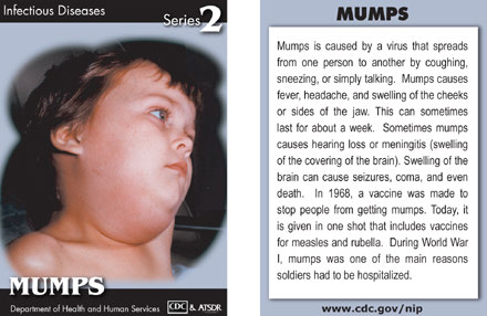 Infectious Disease Trading Cards - Series 2 - Mumps