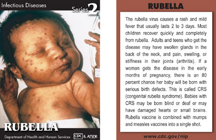 Infectious Disease Trading Cards - Series 2 - Rubella