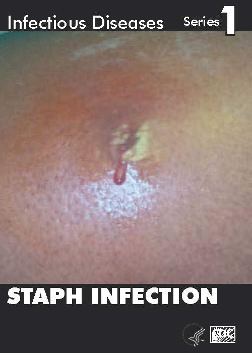 Infectious Disease Trading Cards - Series 1 - Staph Infection - Front